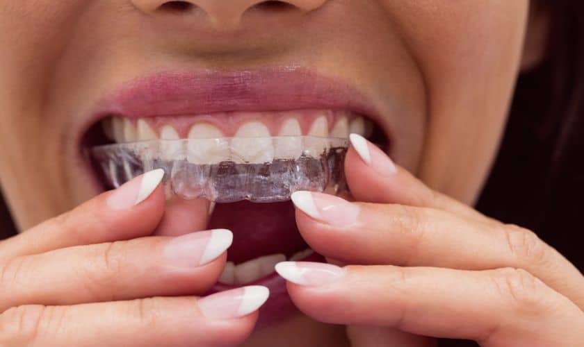 Invisalign: The Clear Solution for Your Teenage Dental Needs
