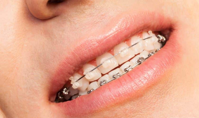 Clear Braces: Straighten Your Smile Discreetly and Confidently