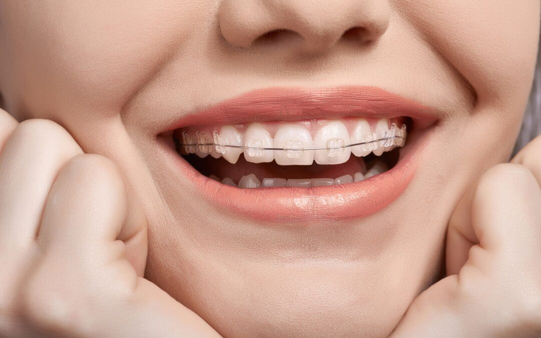 The Advantages of Choosing Clear Braces in Knoxville