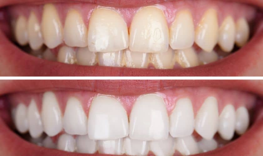 The Connection Between Diet and Teeth Whitening in Knoxville