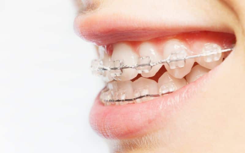 How to Maintain Oral Hygiene with Clear Braces in Knoxville