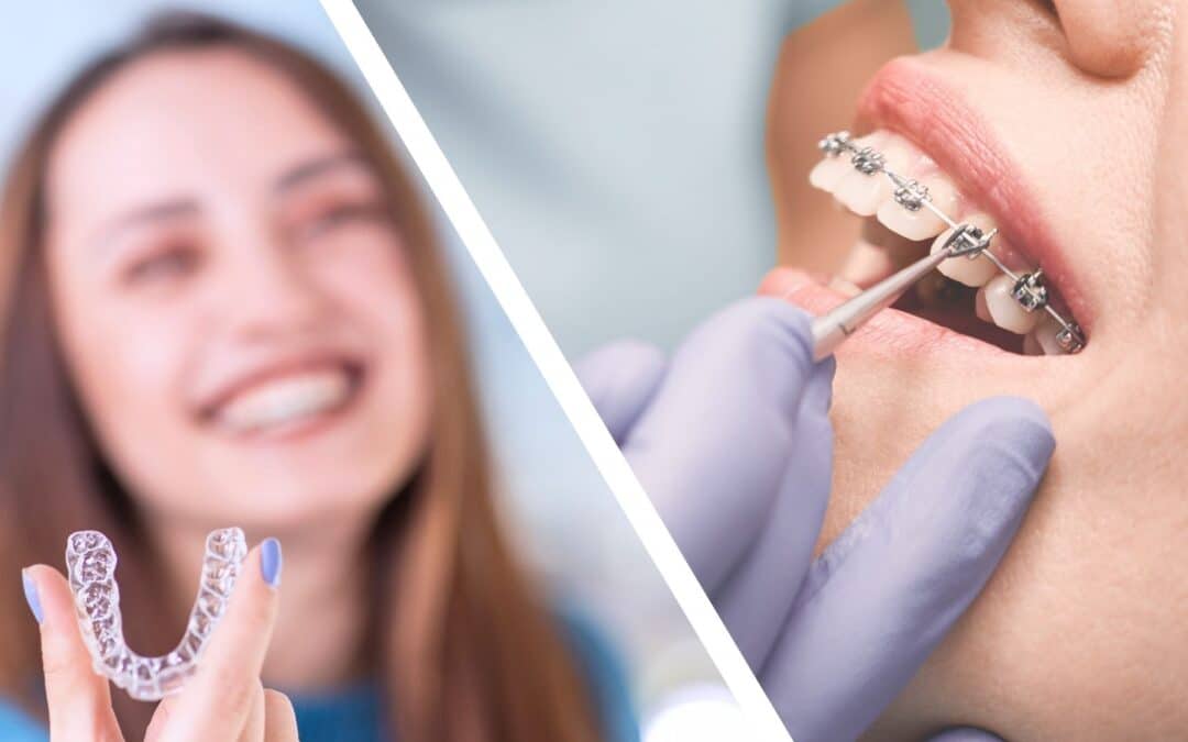 Tips for Taking Care of Your Braces and Invisalign