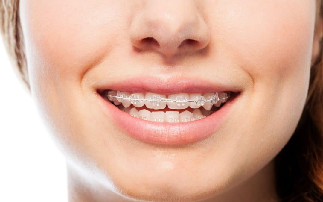 Top Knoxville Orthodontists Offering Clear Braces Treatment