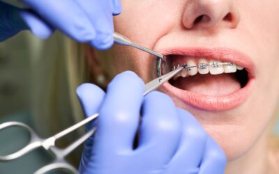 Braces Anxiety? We Can Help! Tips for a Smooth Orthodontic Journey